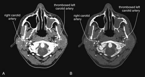 testing soft tissue of the neck|soft tissues in neck ct.